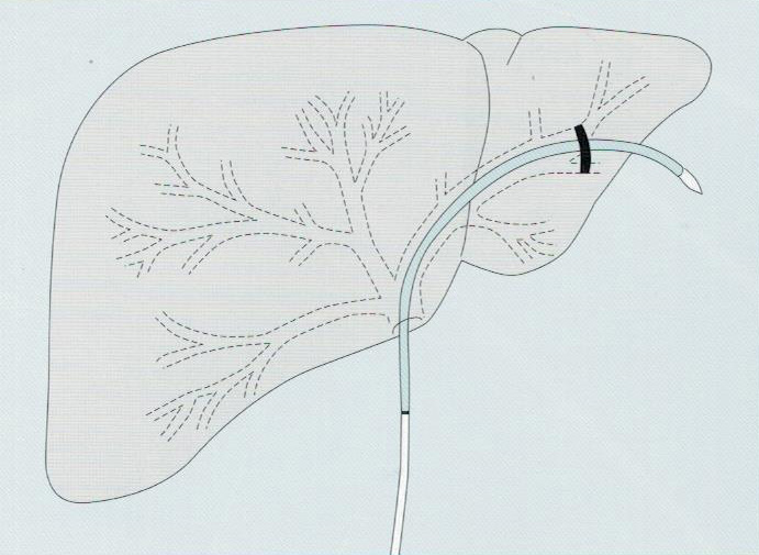 逆行性经胆管引流管1